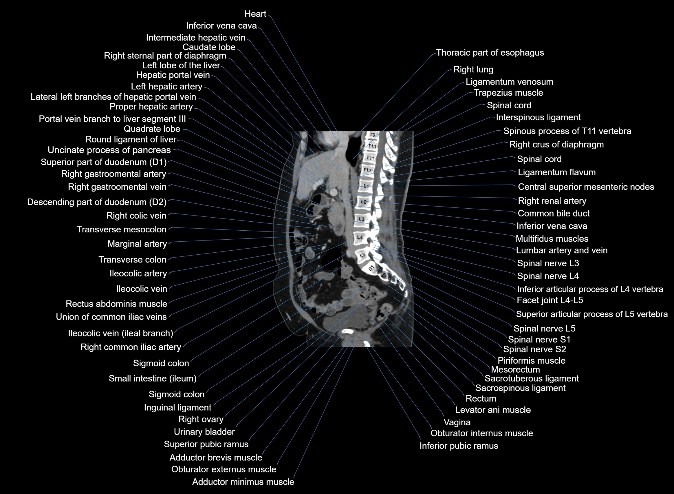 CT Abdomen sagittal cross sectional anatomy labelled radiology image -00065.webp